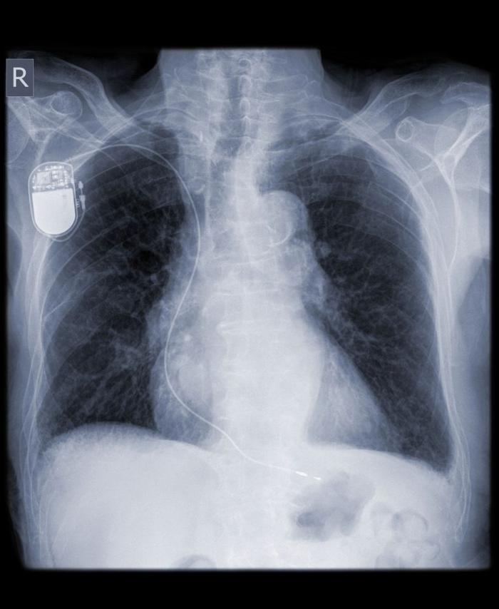 x-ray showing pacemaker